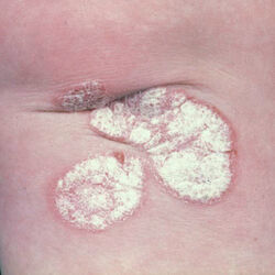 Example of psoriasis